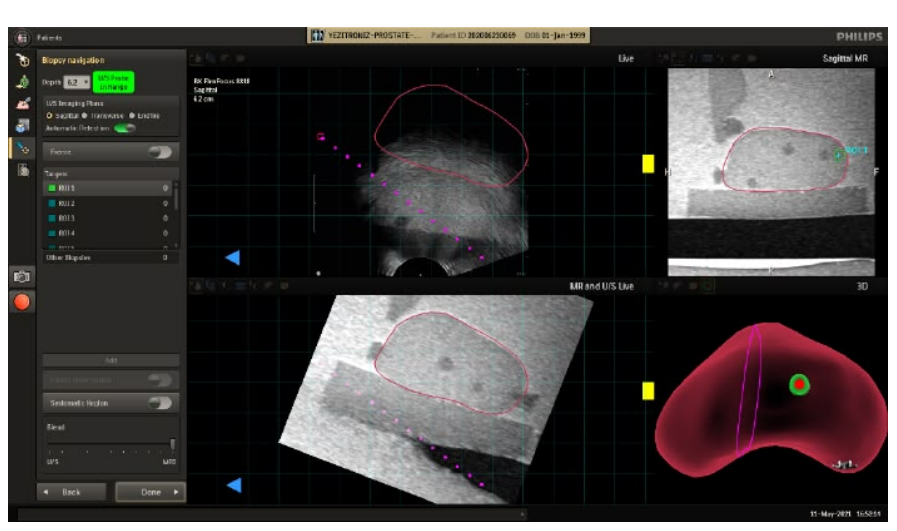 Image showing misalignment between US imaging and EM tracked tools due to improper EM Tracker attachment.