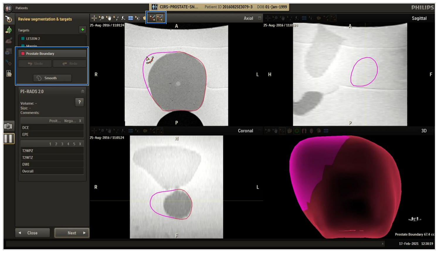 Screenshot of the prostate boundary adjustment interface in the Biopsy workflow.