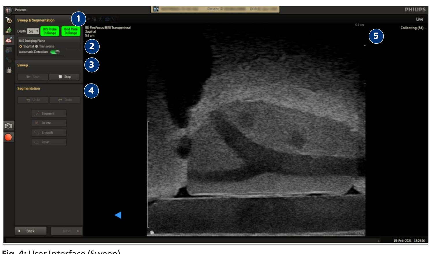 Screenshot of the Sweep interface in the Biopsy workflow, showing numbered callouts for interface elements.