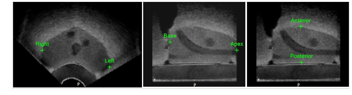 Screenshot of the Place Landmark tool in the segmentation process of the Biopsy workflow.