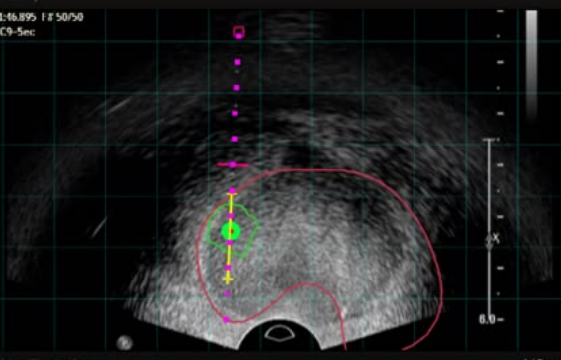 A user interface screenshot or diagram showing transperineal navigation with grid plate overlay.