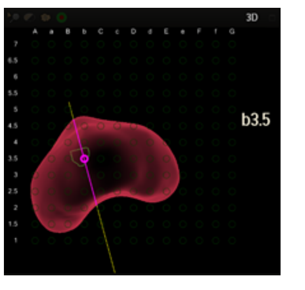 A user interface screenshot or diagram showing free-hand transperineal navigation with a needle guide attached to the ultrasound probe.