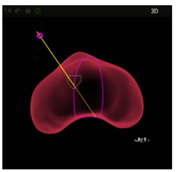 A user interface screenshot or diagram showing free-hand transperineal navigation with a needle guide attached to the ultrasound probe.