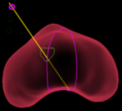 A user interface screenshot or diagram showing free-hand transperineal navigation with a needle guide attached to the ultrasound probe.