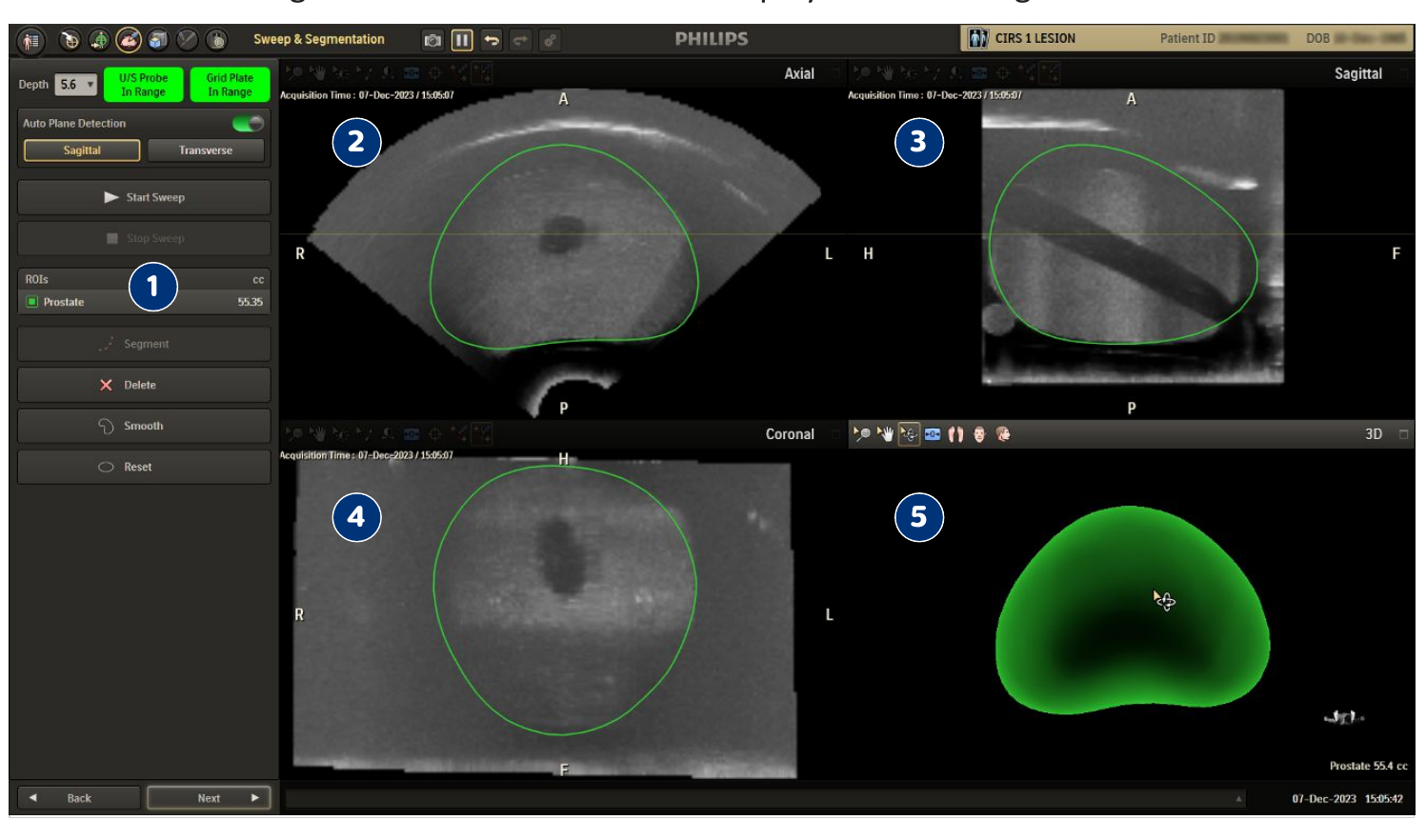 Screenshot showing the segmentation process and 3D model of the prostate ROI.