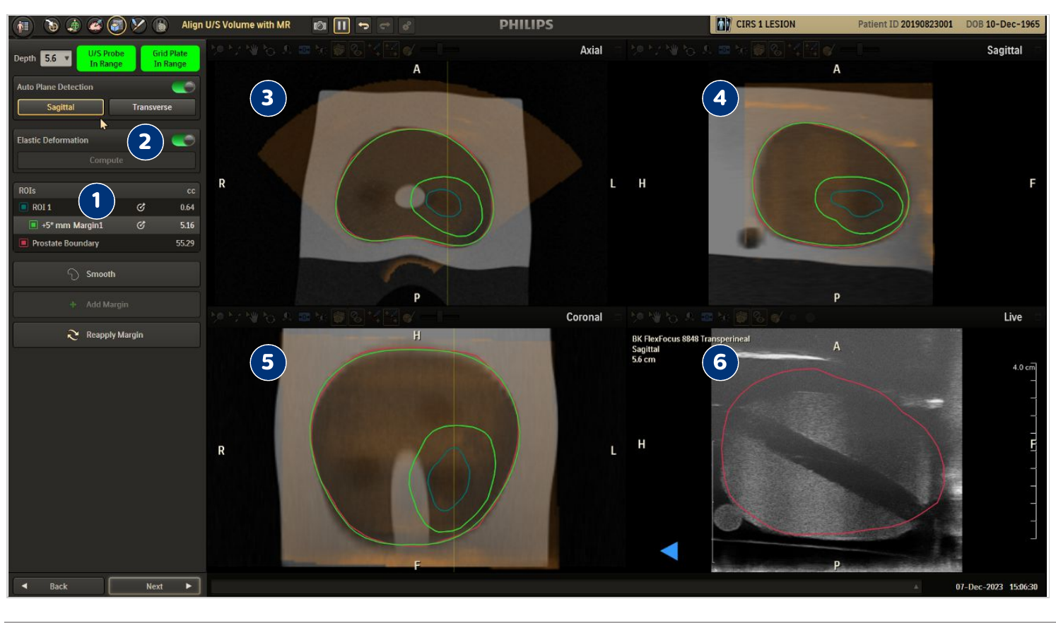Screenshot of the Align US volume with MR screen showing MR and U/S ROI overlays.